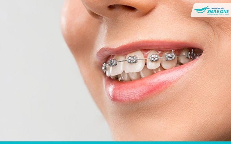 Niềng răng vẩu là giải pháp hiệu quả và an toàn hiện nay