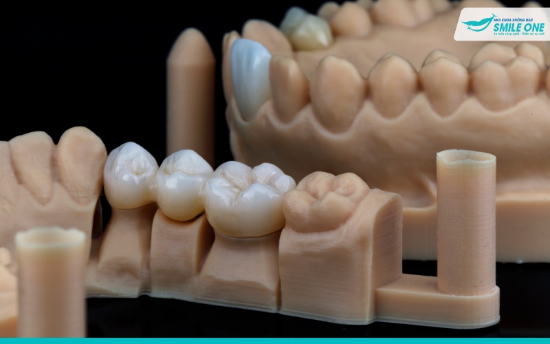 Bọc răng sứ có bền không phụ thuộc vào nhiều yếu tố