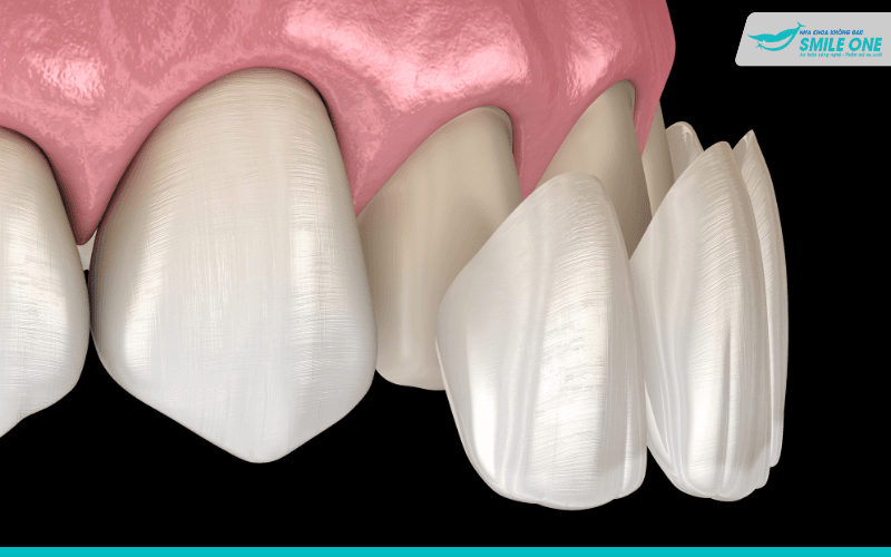 Làm sao để răng hết thưa hở trở nên khít đều đẹp 4