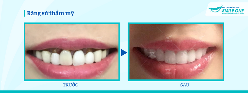 răng sứ thẩm mỹ