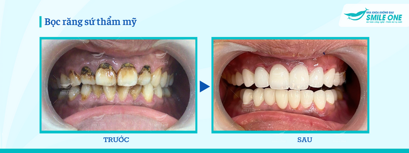 bọc răng sứ thẩm mỹ