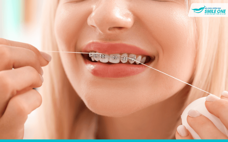 Niềng răng kiêng ăn đồ cứng dai dính để bảo vệ mắc cài