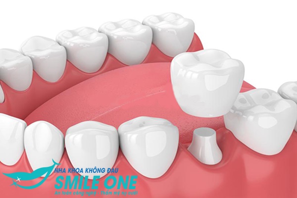 bọc răng sứ thẩm mỹ có đau không