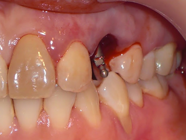 những biến chứng sau khi cấy ghép implant