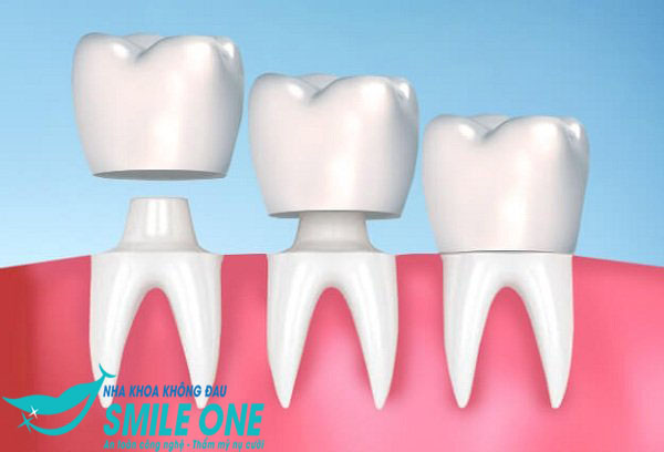 tác hại của bọc răng sứ thẩm mỹ