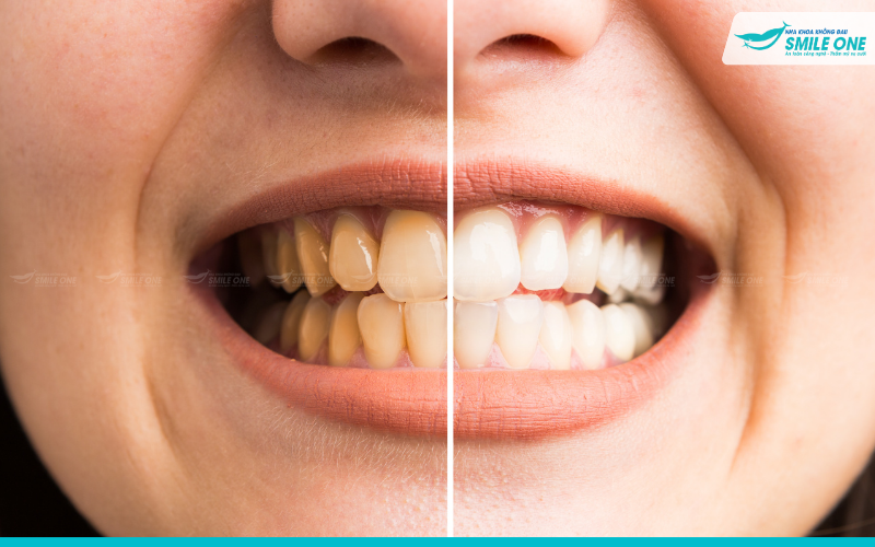TOP 5 cách làm trắng răng hiệu quả - Bạn nên áp dụng ngay 7