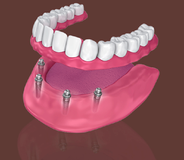 Phương pháp làm hàm giả tháo lắp