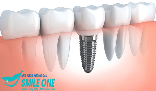 cay-ghep-implant-cao-cap-2