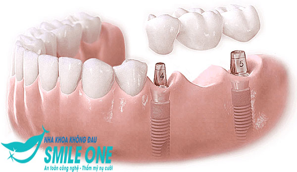 cay-ghep-implant-cao-cap