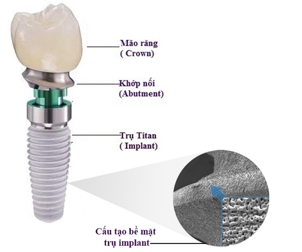 Trụ Implant Osstem Hàn Quốc chính hãng FDA tại Smile One