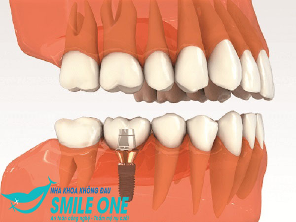 Công nghệ cấy ghép Implant hiện đại 2026 tại Smile One