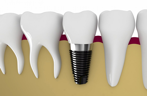 cay-ghep-implant-co-dau-khong-3