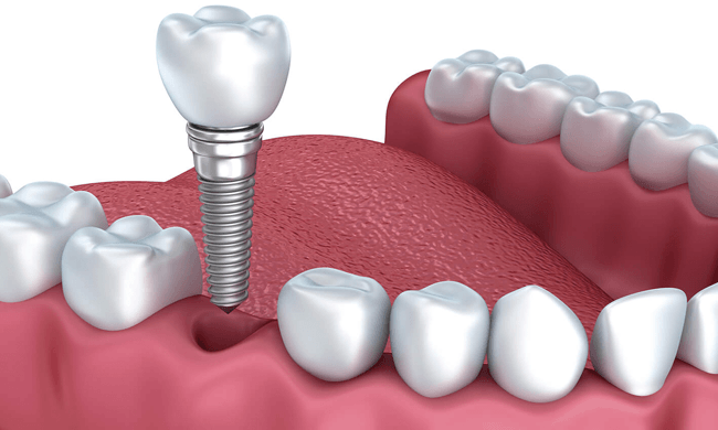 Quy trình cấy ghép implant cho người cao tuổi