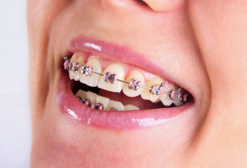 Nguyên nhân dẫn đến dấu hiệu niềng răng hỏng