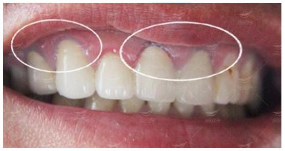 phuong-phap-khac-phuc-tam-giac-nuou