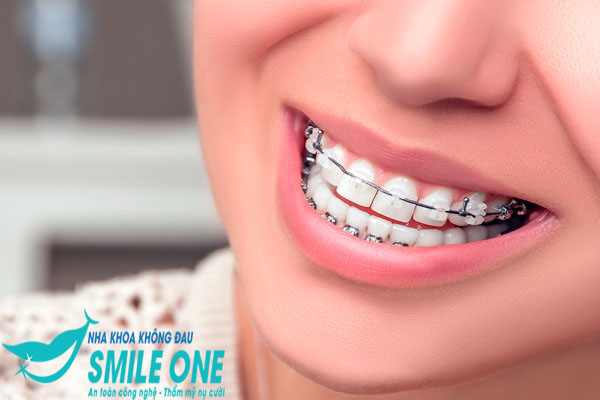hình ảnh niềng răng mắc cài sứ