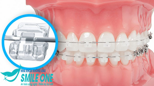 hình ảnh niềng răng mắc cài sứ