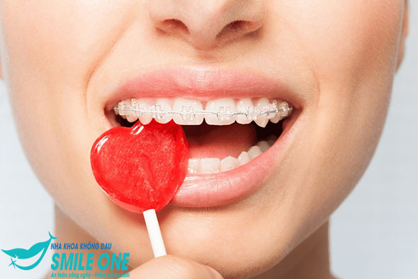 hình ảnh niềng răng mắc cài sứ