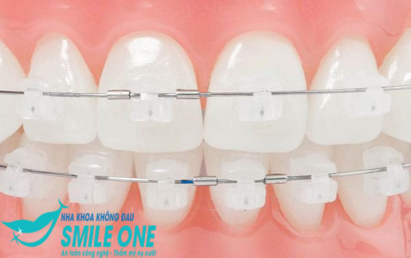hình ảnh niềng răng mắc cài sứ
