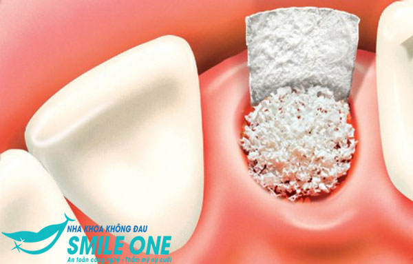 bien-chung-sau-khi-nho-rang-khon-03