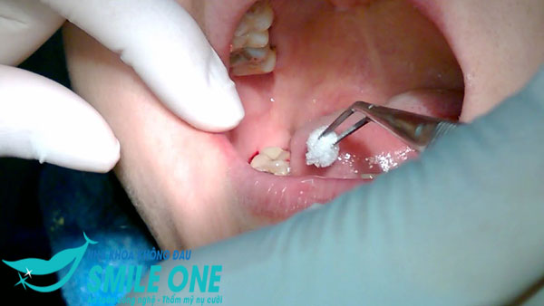 nhổ răng khôn khi mang bầu