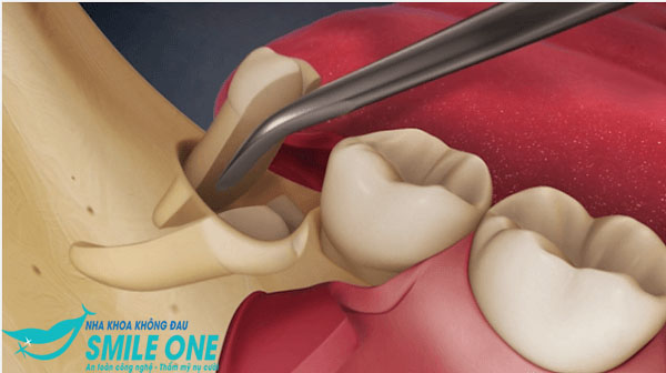 Nhổ răng số 8 có nguy hiểm không