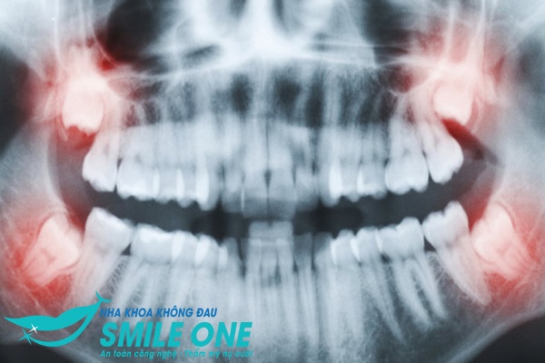 nhổ răng khôn an toàn