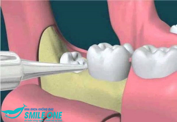 gia-nho-rang-khong-dau