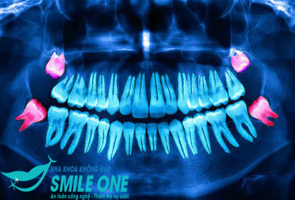 nhổ răng khôn khi nào