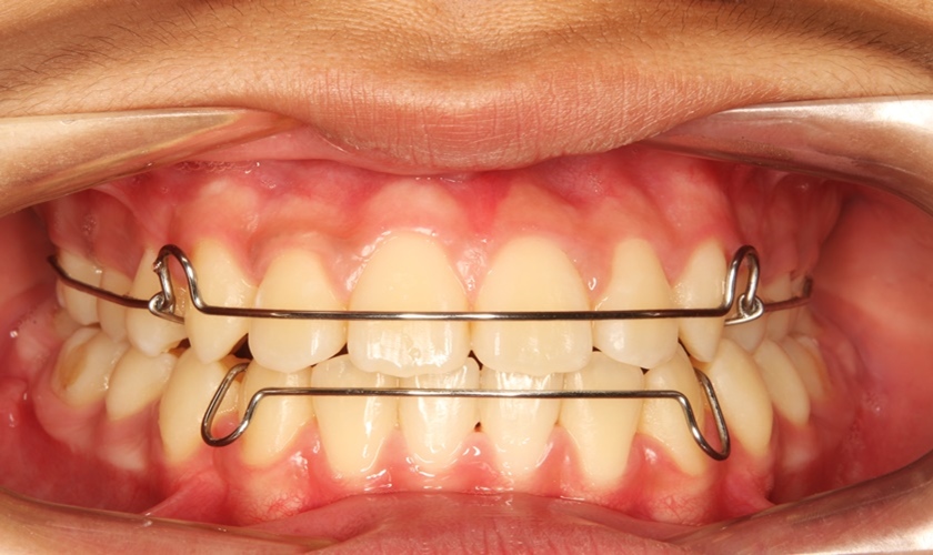 Hàm duy trì sau niềng - 5 loại phổ biến hiện nay