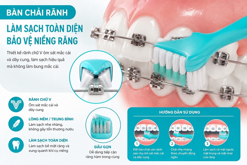 Bàn chải rãnh chữ V (chuyên dụng cho niềng răng)