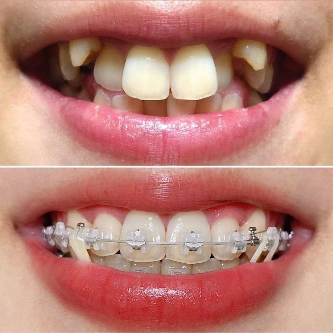 Niềng răng khểnh giúp sắp xếp răng đúng vị trí, tạo khớp cắn chuẩn