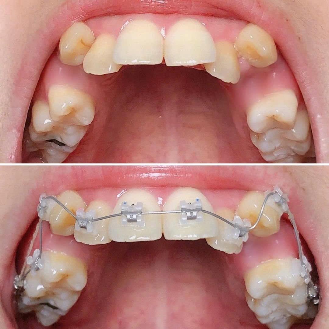 Trước và sau khi niềng răng khểnh – răng đều đẹp, nụ cười hài hòa hơn