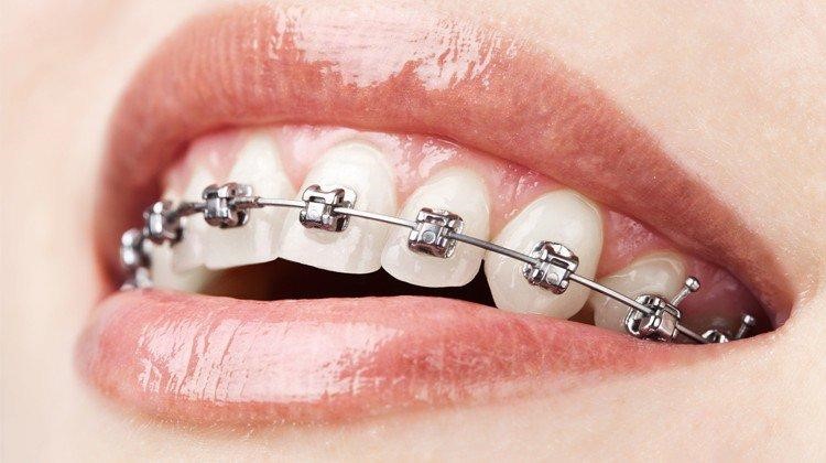 Niềng răng mắc cài tại Smile One - giải pháp chỉnh nha cho mọi tình trạng