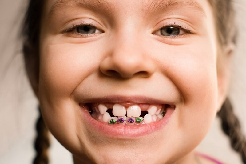 Case study niềng mắc cài thực tế - Lê Khánh Ngọc tại Smile One Hà Nội