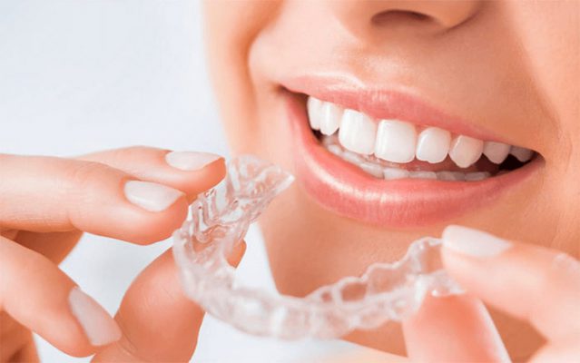 Vệ sinh răng miệng đúng cách khi đang niềng mắc cài