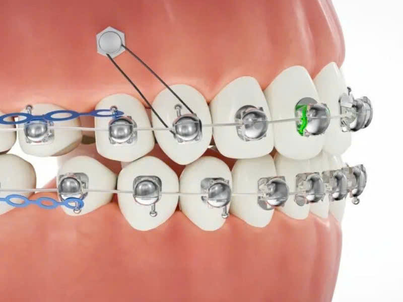 Các loại mắc cài cánh cam kim loại và sứ