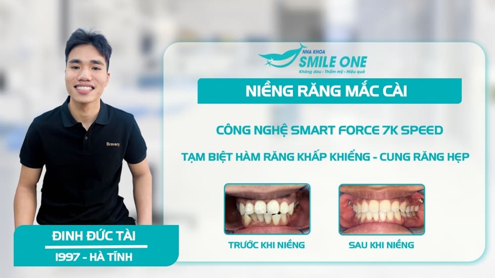 Khách hàng niềng răng mắc cài cánh cam tại Smile One