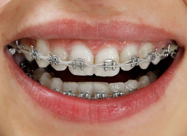 Niềng răng mắc cài kim loại tại Nha khoa Smile One – phương pháp chỉnh nha hiệu quả và bền vững