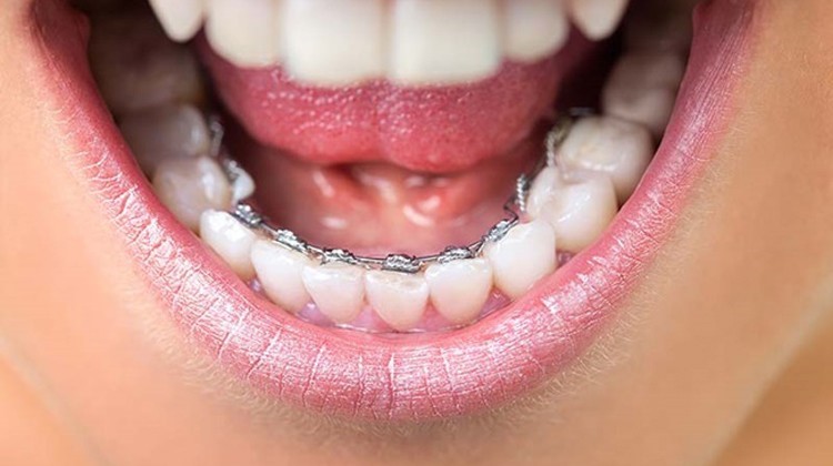 Mắc cài gắn vào mặt sau răng, chúng vô hình 100%
