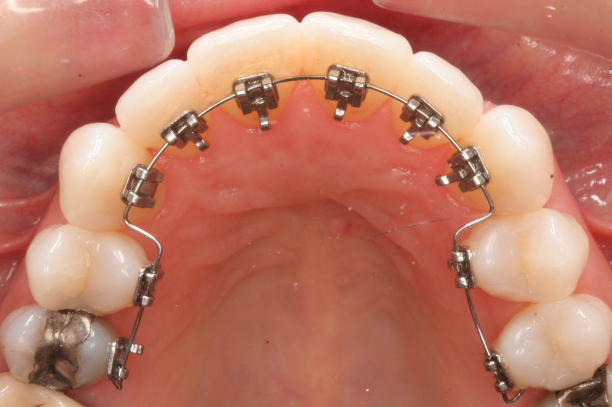 Niềng răng bằng mắc cài mặt trong có nhiều điểm khác Invisalign