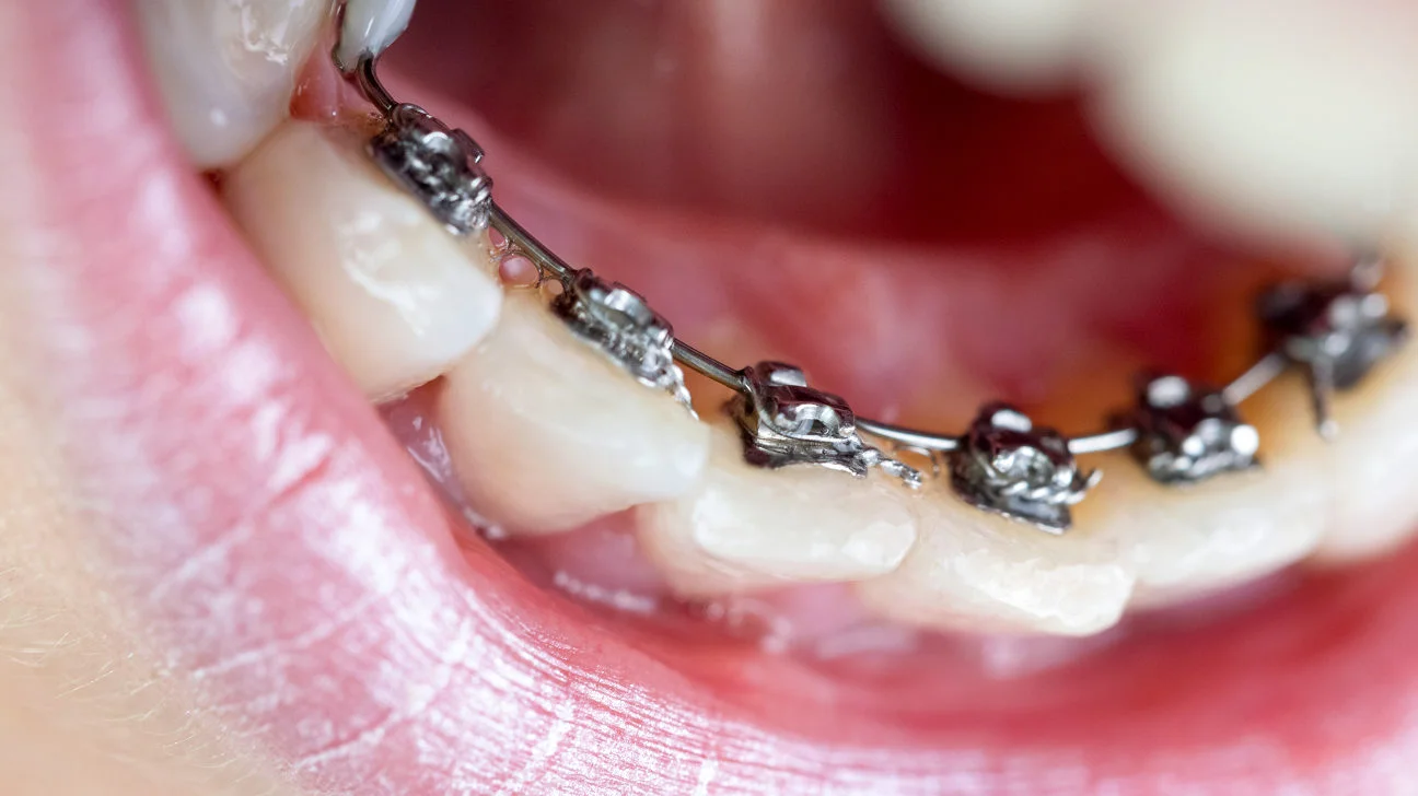 Niềng răng mắc cài mặt trong kéo dài trong 18 – 36 tháng