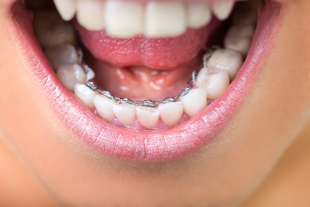 niềng răng mắc cài mặt trong cần kỹ thuật tốt, bác sĩ có tay nghề cao