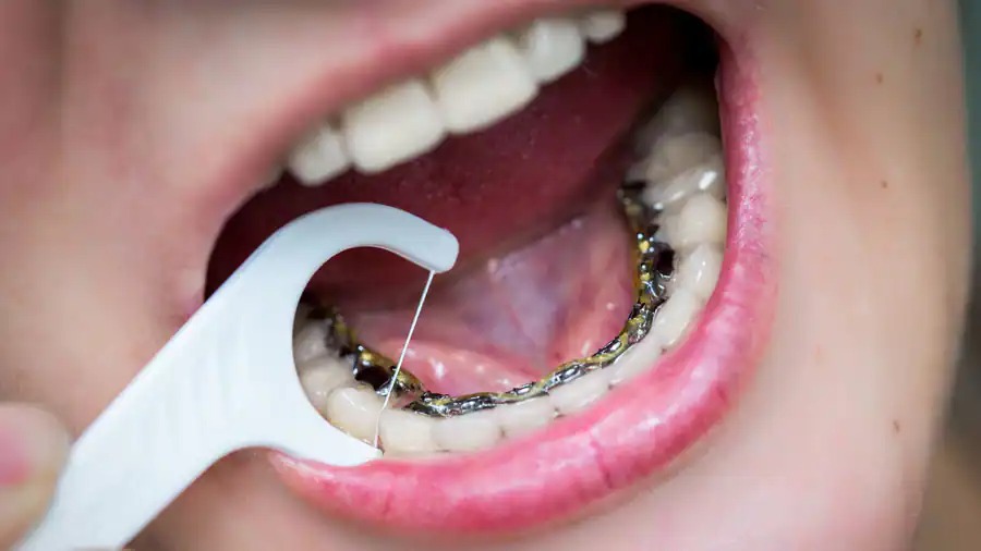 người dùng tăm nha khoa để niềng răng mắc cài