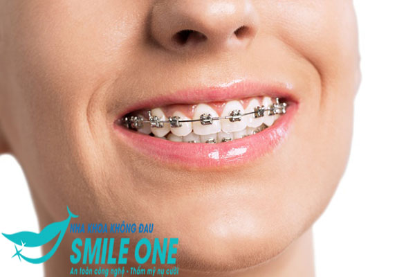 Cách chọn mắc cài niềng răng phù hợp theo nhu cầu
