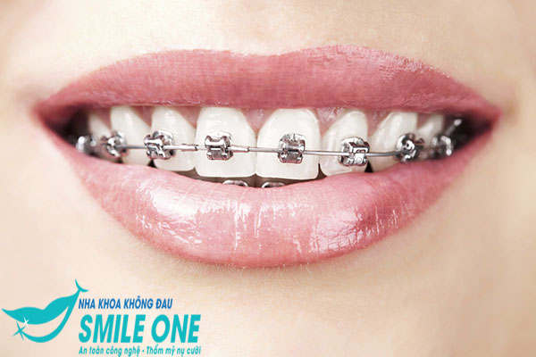 Niềng răng mắc cài nào tốt - 4 loại mắc cài phổ biến