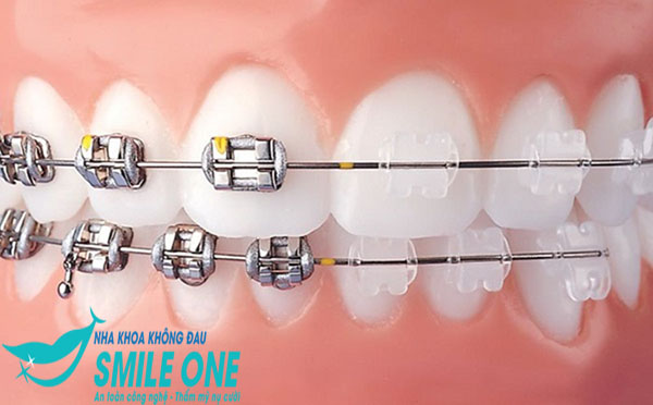 niềng răng mắc cài sứ và kim loại
