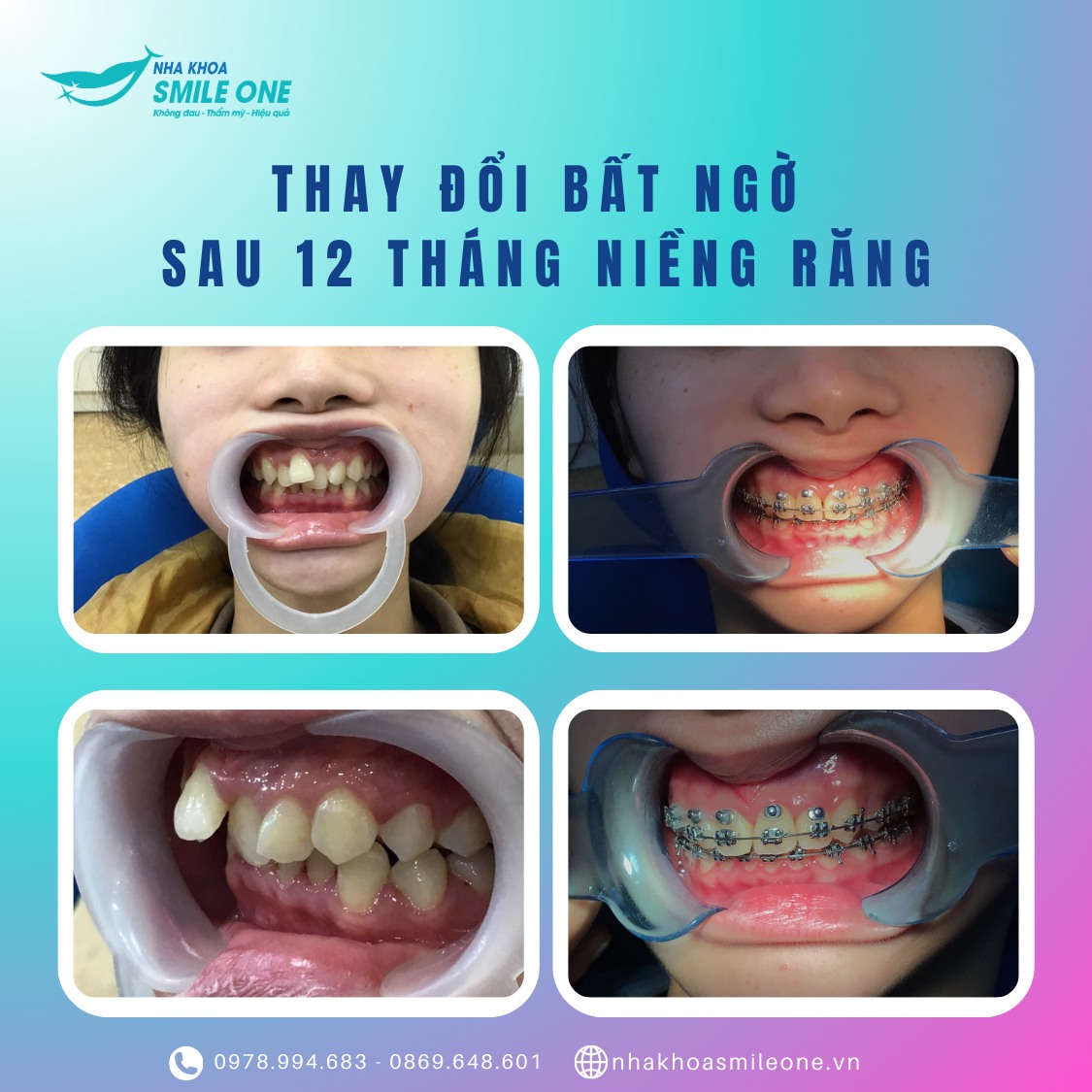 Kết quả niềng răng mắc cài sứ sau 12 tháng – cải thiện nụ cười rõ rệt