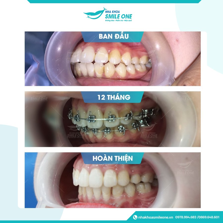 Cận cảnh niềng răng mắc cài sứ – khay mắc cài trong suốt, thẩm mỹ cao