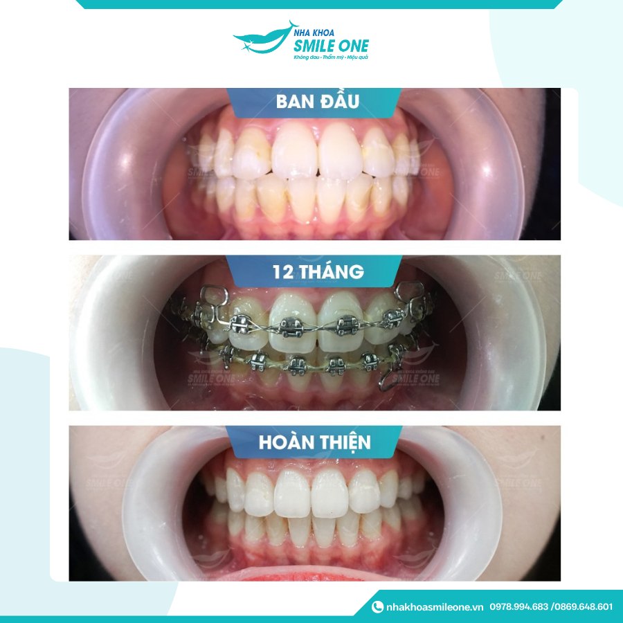 So sánh trước và sau niềng răng mắc cài sứ – răng đều, khớp cắn chuẩn hơn